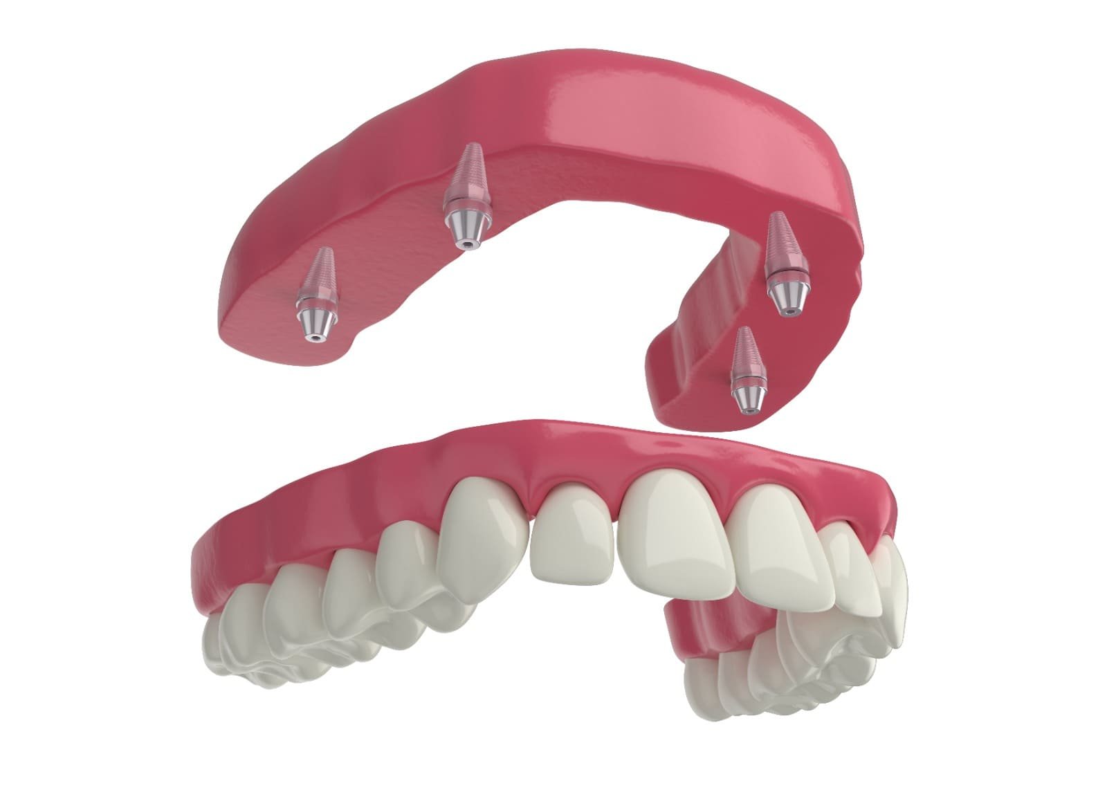 Snap-On types of dentures